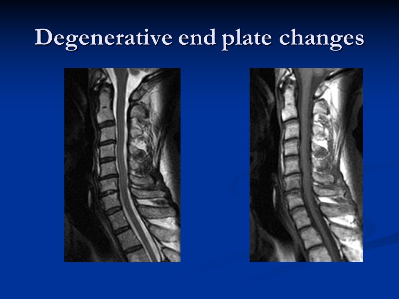 Degenerative end plate changes